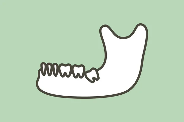 Muela Del Juicio Impactación Angular Mesial Mandíbula Mandíbula Inferior Caricatura — Archivo Imágenes Vectoriales