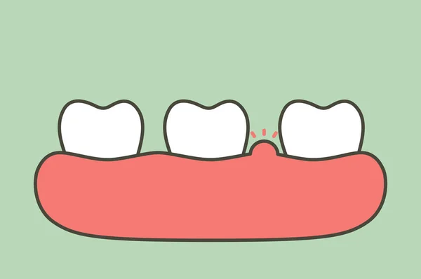 Parodontite Malattia Gengivale Con Gonfiore Gonfiore Gengiva Dente Perché Infiammazione — Vettoriale Stock