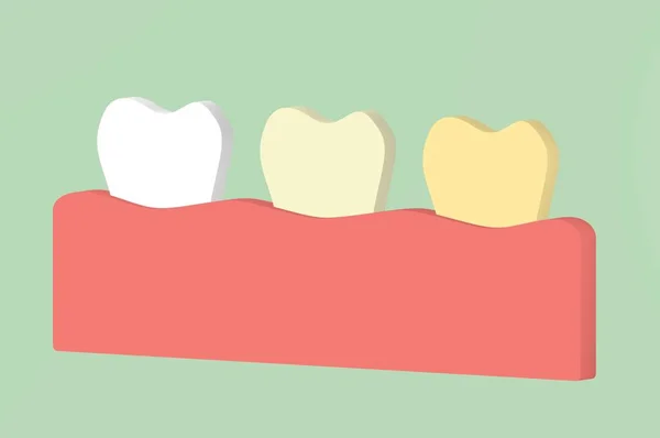 白黄色の歯をホワイトニング 歯科の概念設計のための レンダリング フラット スタイルかわいいキャラクターを漫画 — ストック写真