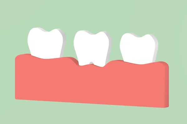 Ząb Przyzębia Lub Zapalenie Dziąseł Choroby Dziąseł Dental Render Płaski — Zdjęcie stockowe