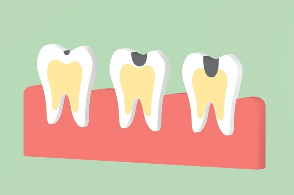 Krok Próchnicy Zębów Dental Kreskówka Znaków Płaski Render Ładny Design — Zdjęcie stockowe