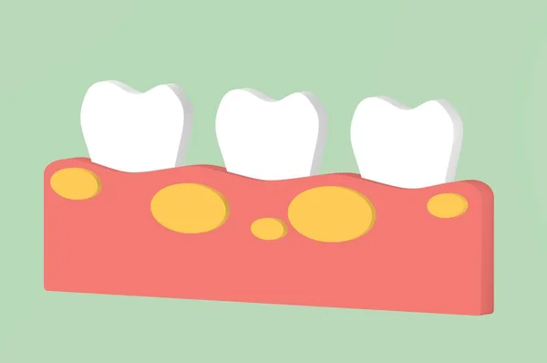 Dentes Insalubres Porque Gengivite Com Abscesso Gengiva Desenho Animado Dental — Fotografia de Stock