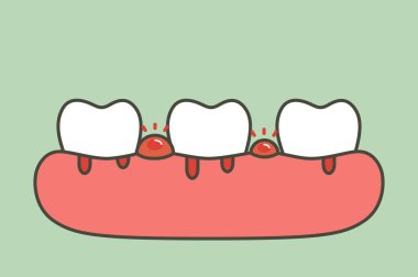 kanama periodontitis veya dişeti hastalığı (kan akımı geliyor dişeti ve diş), diş diş sorunu - karikatür vektör düz stil şirin karakter tasarımı için