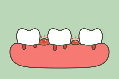 periodontitis or gum disease with bleeding ( blood flow come from gum and tooth ), dental problem - teeth cartoon vector flat style cute character for design clipart