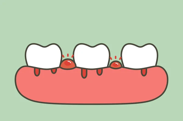 牙周炎或牙龈疾病出血 血流来自牙龈和牙齿 牙科问题 牙齿卡通矢量扁平式设计的可爱字符 — 图库矢量图片