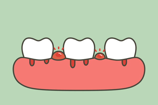 periodontitis or gum disease with bleeding ( blood flow come from gum and tooth ), dental problem - teeth cartoon vector flat style cute character for design