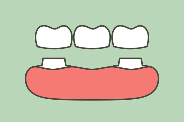 Couronne Dentaire Avec Pont Processus Installation Changement Dents Dent Dessin — Image vectorielle