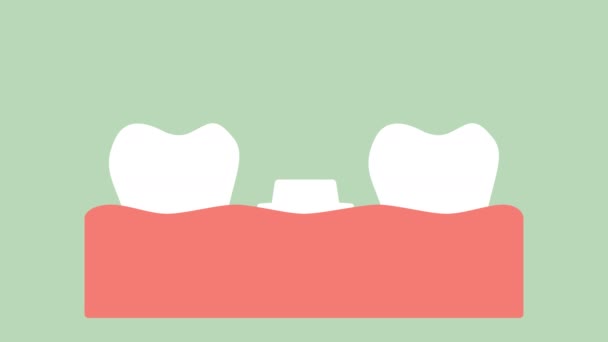 Стоматологическая Коронка Процесс Установки Замены Зубов Вектор Зуба Плоский Стиль — стоковое видео