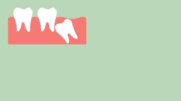 Type Wisdom Tooth Mesial Impaction Distal Impaction Horizontal Impaction Vertical — Stock Video