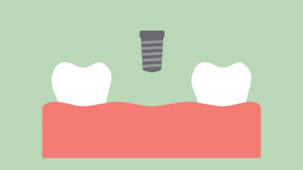 Стоматологический Имплантат Процесс Установки Замены Зубов Вектор Зуба Плоский Стиль — стоковое видео