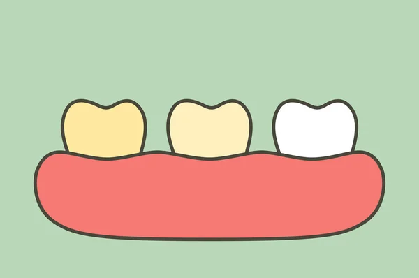 Dente Amarelo Branco Clareamento Dos Dentes Antes Depois Desenho Animado — Vetor de Stock