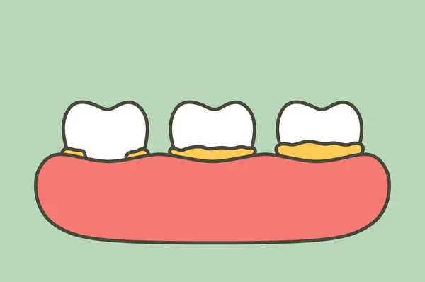 adım plak veya tartar, diş periodontal hastalığın - diş çizgi film vektör düz stil şirin karakter tasarımı için nedeni