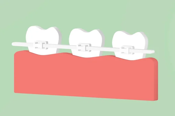 Dentes Ortodônticos Aparelho Dentário Desenho Animado Dente Renderizar Caráter Bonito — Fotografia de Stock