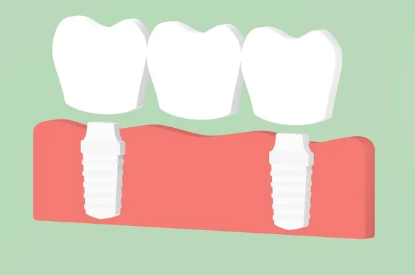 Implante Dentário Com Ponte Processo Instalação Mudança Dentes Desenho Animado — Fotografia de Stock