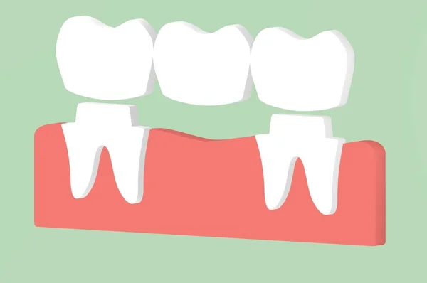 dental crown with bridge, installation process and change of teeth