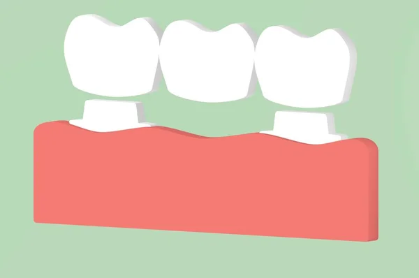 Korona dentystyczna z mostkiem, proces instalacji i zmiana zębów — Zdjęcie stockowe