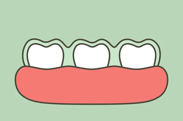 Dentes usam treinador de silicone ou aparelho invisível, conceito de saúde dental —  Vetores de Stock