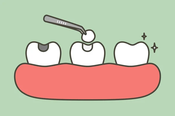 Passo de preenchimento de amálgama dentária por ferramentas dentárias para proteção do dente decadente, antes e depois — Vetor de Stock