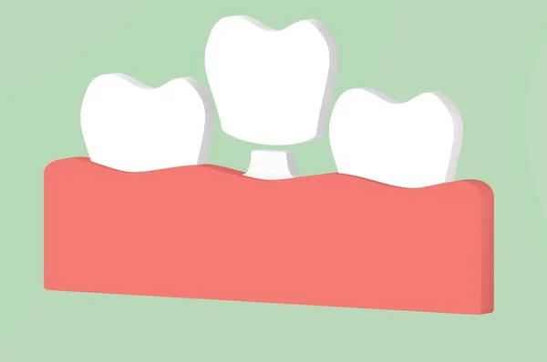Implante dentário, processo de instalação e troca de dentes — Fotografia de Stock