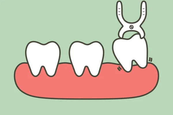 Видалення зуба зубними інструментами для видалення зуба мудрості — стоковий вектор