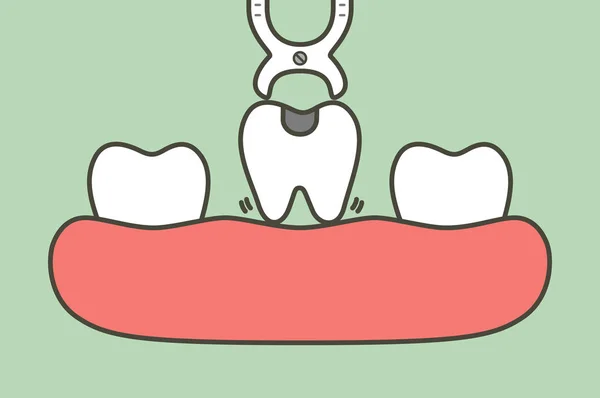 Extração dentária por ferramentas dentárias para remover o dente decadente — Vetor de Stock