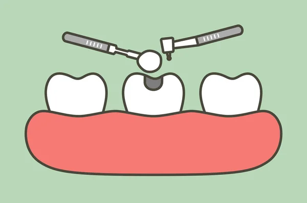 Passo de preenchimento de amálgama dentária por ferramentas dentárias