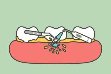 teeth scaling, dental plaque removal for cleaning clipart
