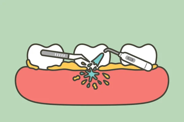 Descamação dos dentes, remoção de placa dentária para limpeza —  Vetores de Stock