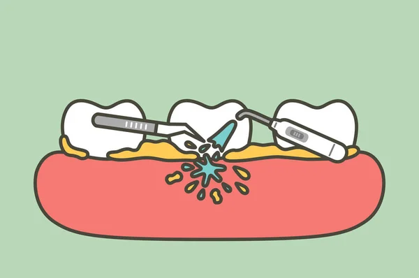 Tänder som skalning, plackborttagning för rengöring — Stock vektor