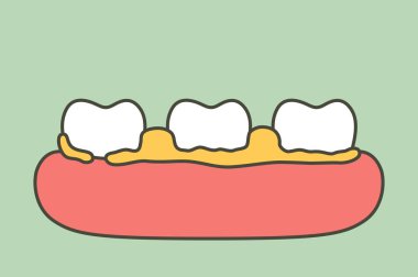 plak veya tartar, diş periodontal hastalık nedeni