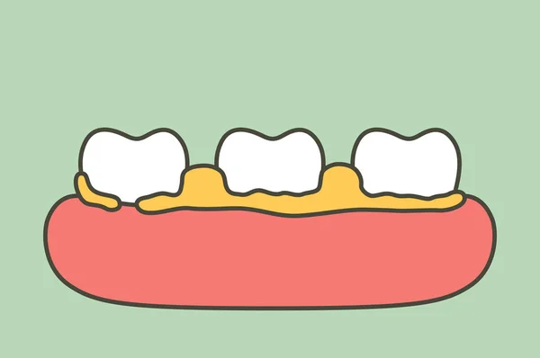 Placa ou tártaro, causa da doença periodontal do dente — Vetor de Stock