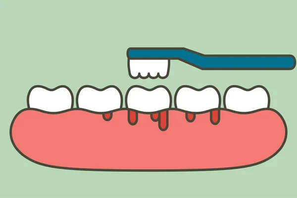 Escovar os dentes com sangramento na gengiva e dente, gengivite ou conceito escorbuto —  Vetores de Stock