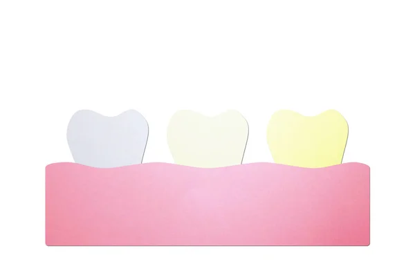 Špatná hygiena nebo nezdravé zuby koncept, bílá až žlutá zub — Stock fotografie