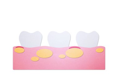 sağlıksız diş çünkü gingivitis apse dişeti ve dental plak veya tartar ile
