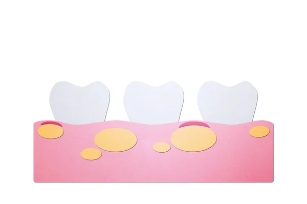 Ohälsosamma tänder eftersom gingivit med abscess i tuggummi och plack eller tandsten — Stockfoto