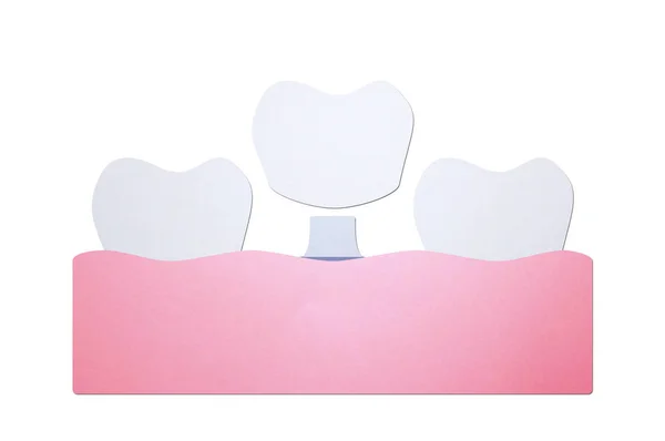 Zubní implantát, proces instalace a změnit nový kořenový adresář pro zuby — Stock fotografie