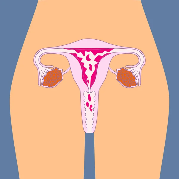 Menstruáció Egy Havi Vérzés Menstruációs Vérzés Női Test Egészségügyi Vektoros — Stock Vector