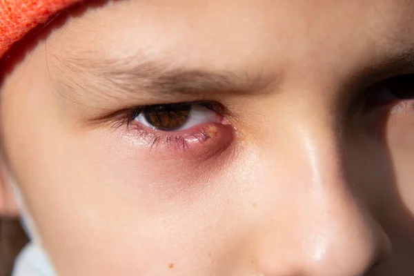 Воспаление Глазного Яблока Детский Холодный Ячмень Лицензионные Стоковые Изображения