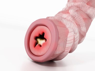 Astım temsil eden bronşiyal tüp illüstrasyon tıkalı. 3D çizim.