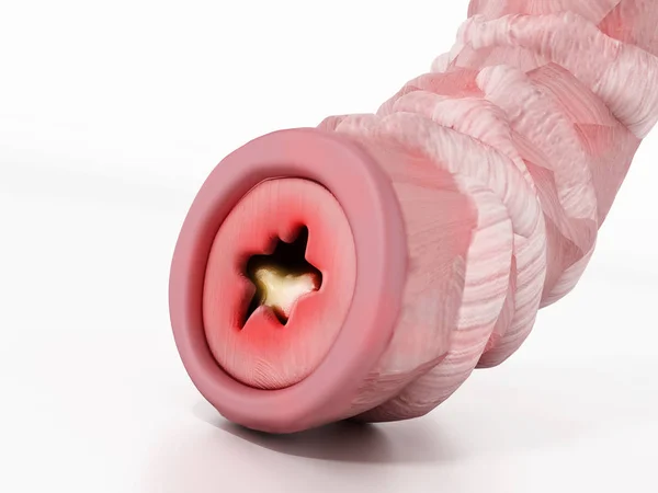 Illustration Tube Bronchique Obstrué Représentant Asthme Illustration — Photo