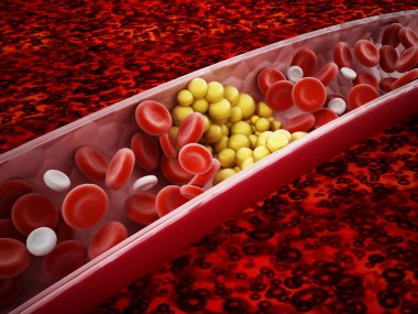 Fat cells blocking the blood flow inside human vein. 3D illustration clipart