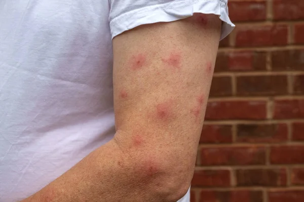 一个穿着T恤的成熟男人对蚊子咬伤他的胳膊会表现出强烈的反应 — 图库照片