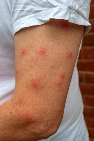 A mature man dressed in a t shirt displays a strong reaction to the mosquito bites on his bare arm