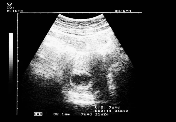 Hafta Boyunca Insan Fetüsünün Ultrasonu — Stok fotoğraf