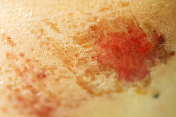 Lesion Knee Scraped Knee Broken Bleeding Knee Deep Scratches Skin — Stock Photo, Image