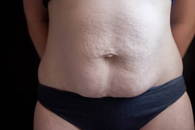 Beyaz kadın, hamilelikten sonra cildinde çizikler ve doğum izleri gösteriyor. Diastasis recti kavramı, lezyon derisi