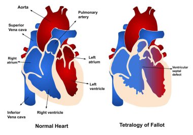 Doğuştan kalp hastalığı: Fallot Tetralojisi