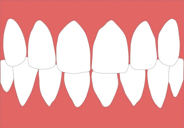 Zahnersatz Mit Weißen Zähnen Das Zahnfleisch Des Ober Und Unterkiefers — Stockfoto