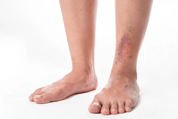 Asyalı kadınların bacakları beyaz arka planda kazadan dolayı morarmış..