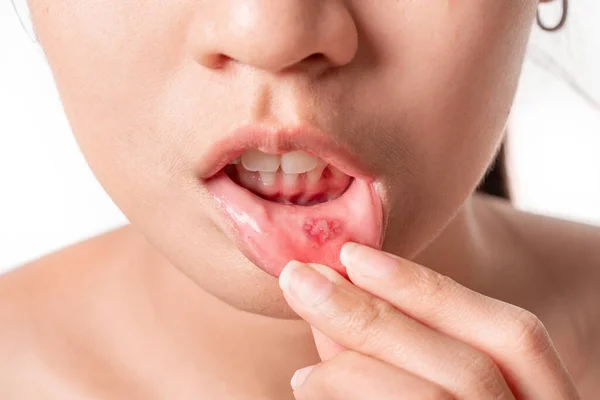 アジアの女性は 白い背景に口の中に多形性潰瘍を持っています 選択的な焦点 — ストック写真